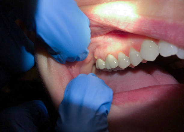 Best Emergency Denture Repair in Dunkirk, IN