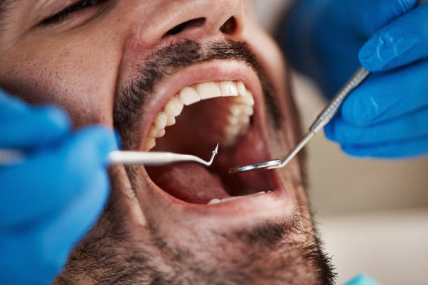 Best Dental Abscess Treatment in Dunkirk, IN
